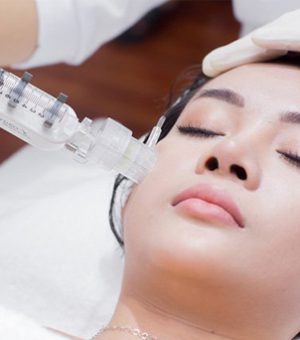 Cấy HA Colagen căng bóng